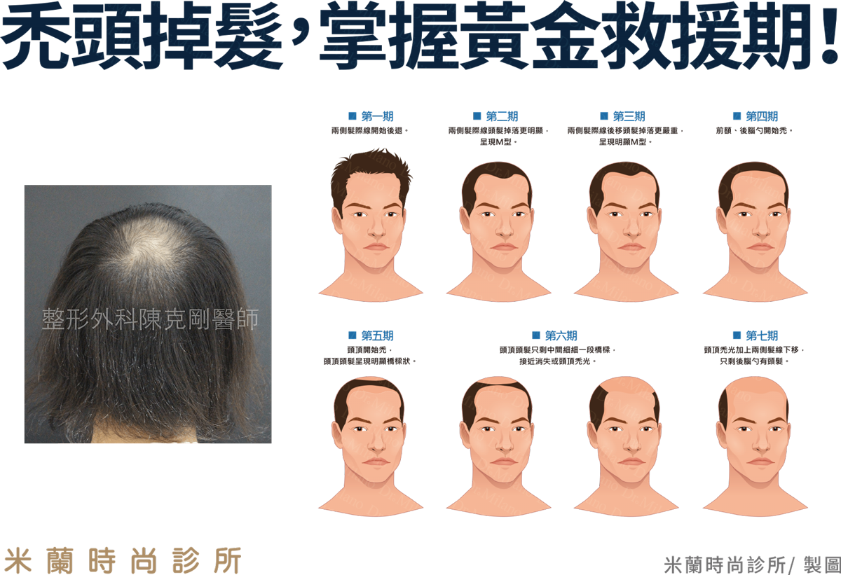 M型禿/地中海型禿頭