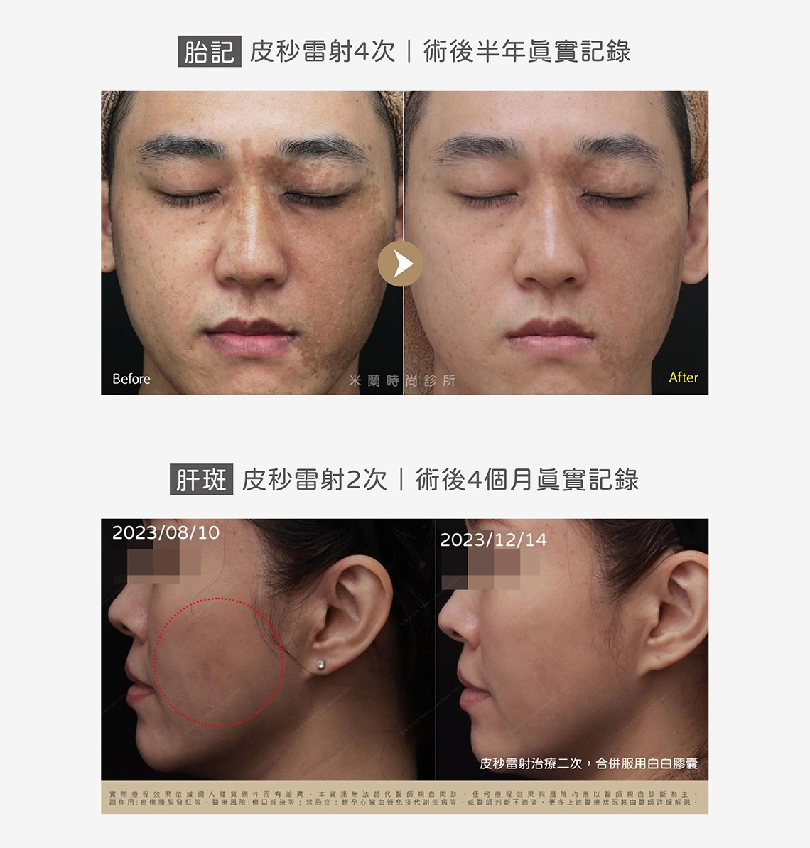 皮秒雷射原理