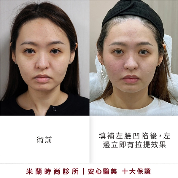 左臉拉提 (階段性提升)