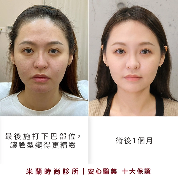 術後 1 個月 (最終成果，美得更有智慧)
