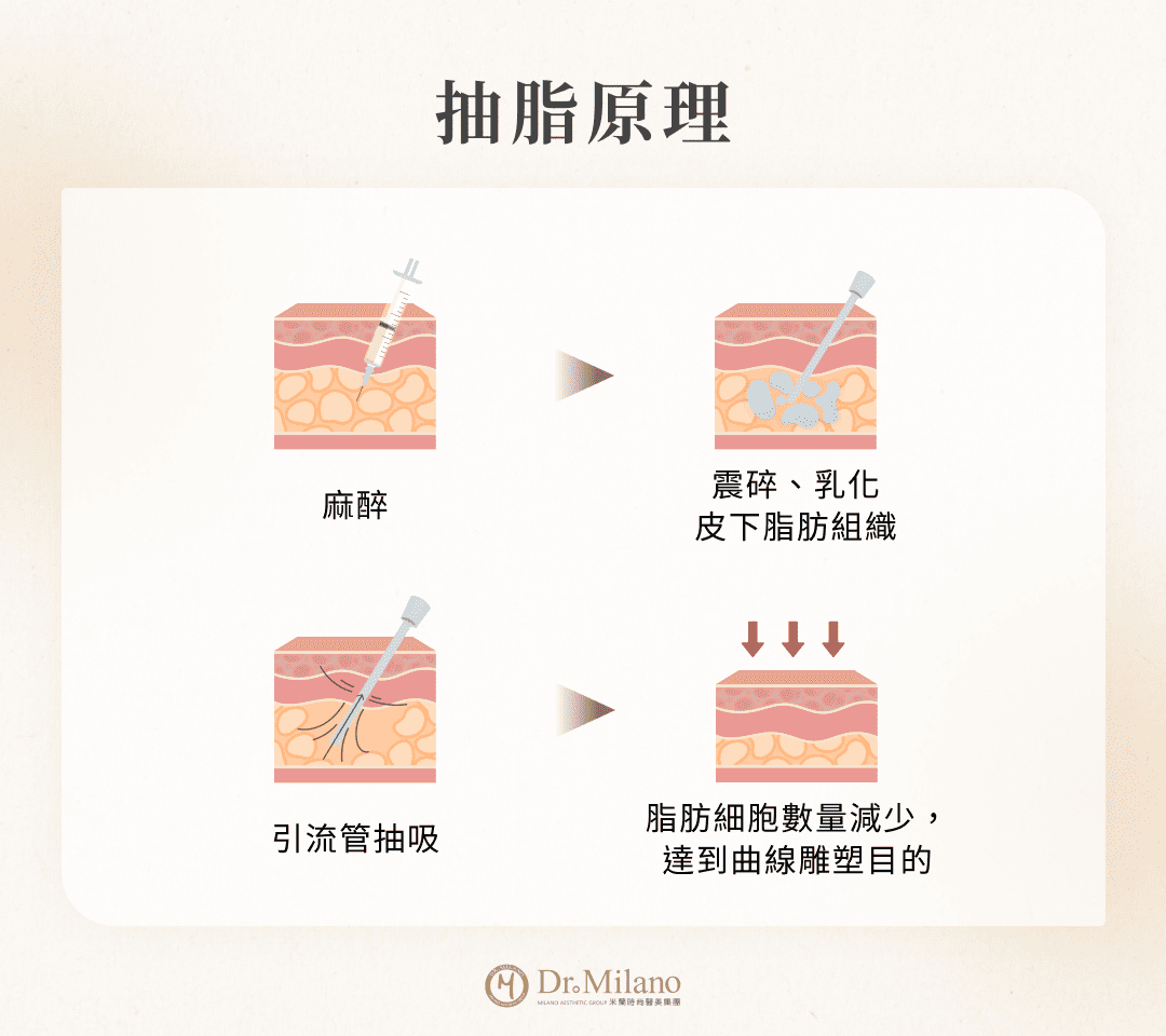 抽脂手術原理圖解：包含局部麻醉、震碎與乳化皮下脂肪組織、引流管抽吸，達成曲線雕塑效果。