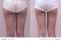 大腿米蘭隱痕 飛塑減脂，正妹蜜桃的韓系美腿計劃