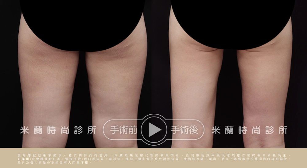 大腿環抽術後六的月術前術後對比