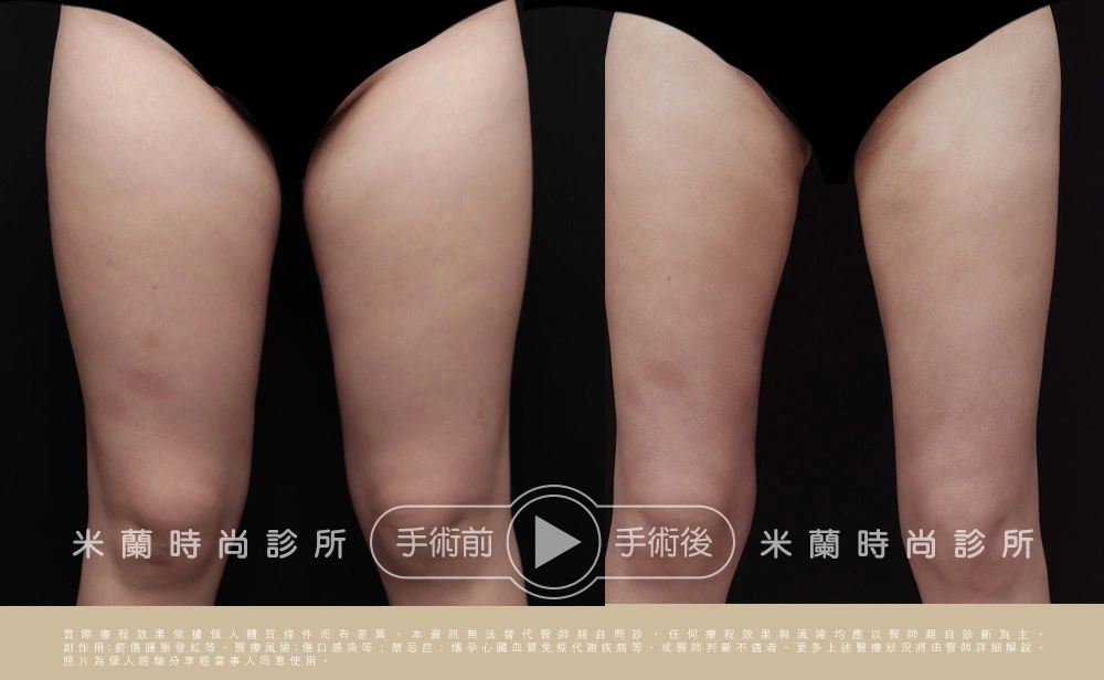 大腿環抽術後六的月術前術後對比
