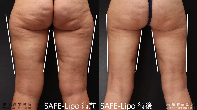  SAFE-Lipo 抽脂原則的成果