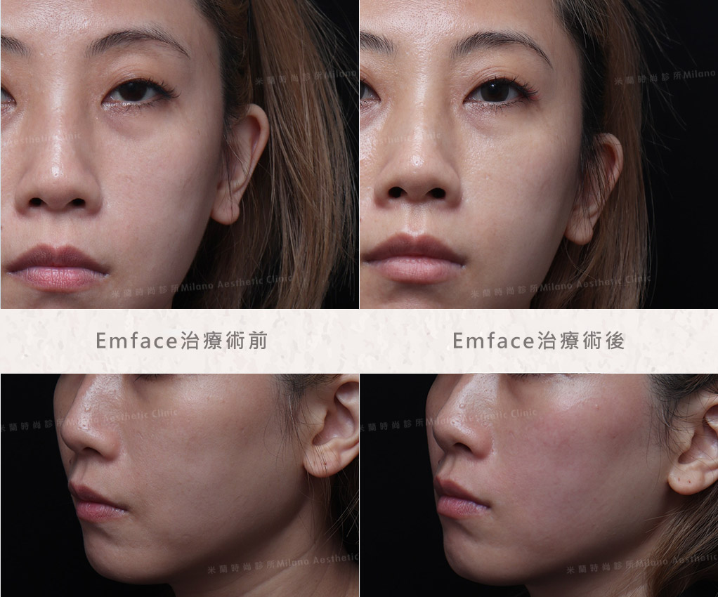 Emface菲斯波療程術後立即後對照