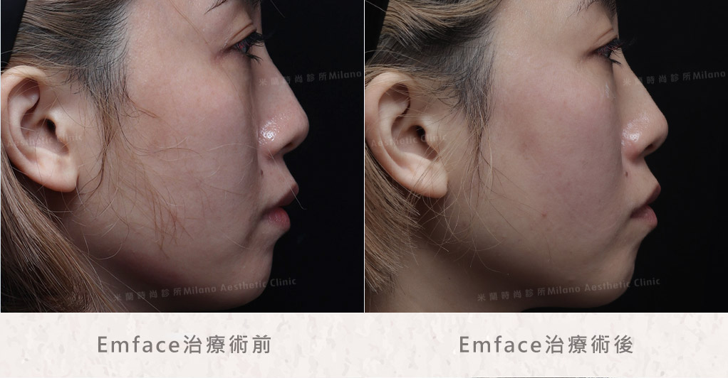 Emface菲斯波療程術後立即後對照