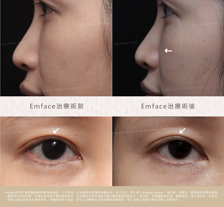 Emface菲斯波療程術後一個月後對照