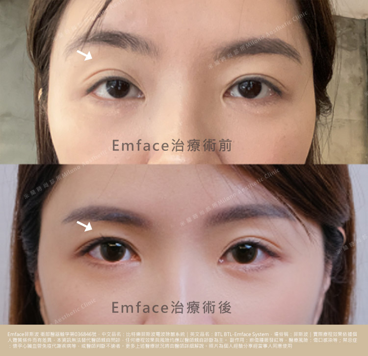 Emface菲斯波療程術後一個月後對照