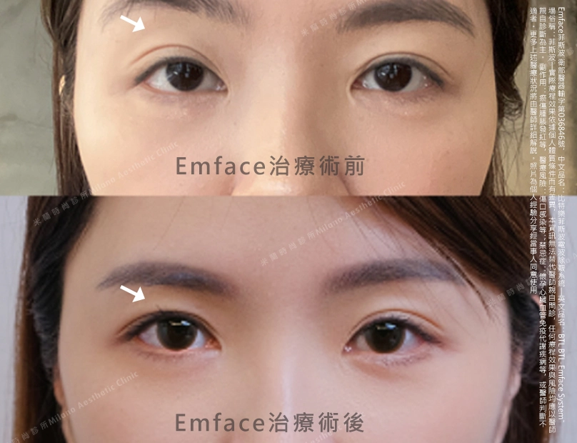 Emface效果術後一個月對比