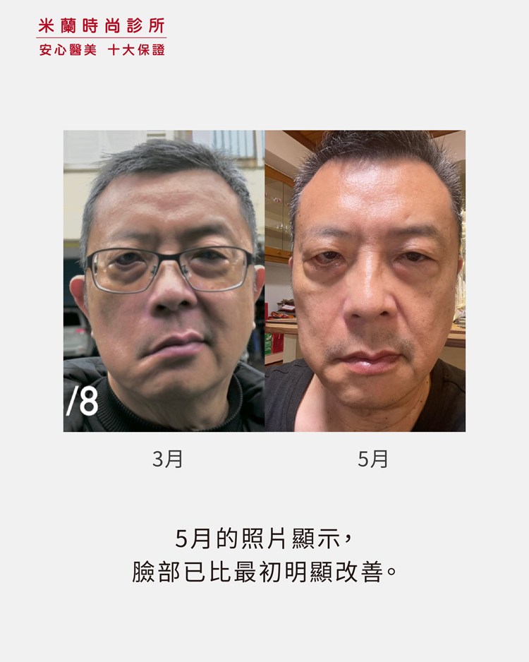 3月5月對比照