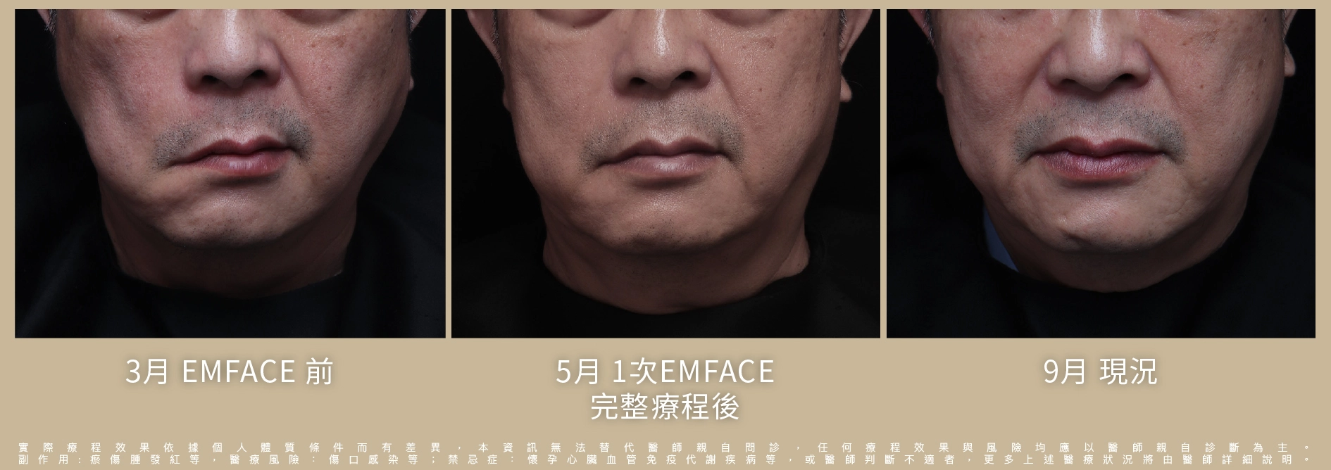 Emface菲斯波療程後對比照片