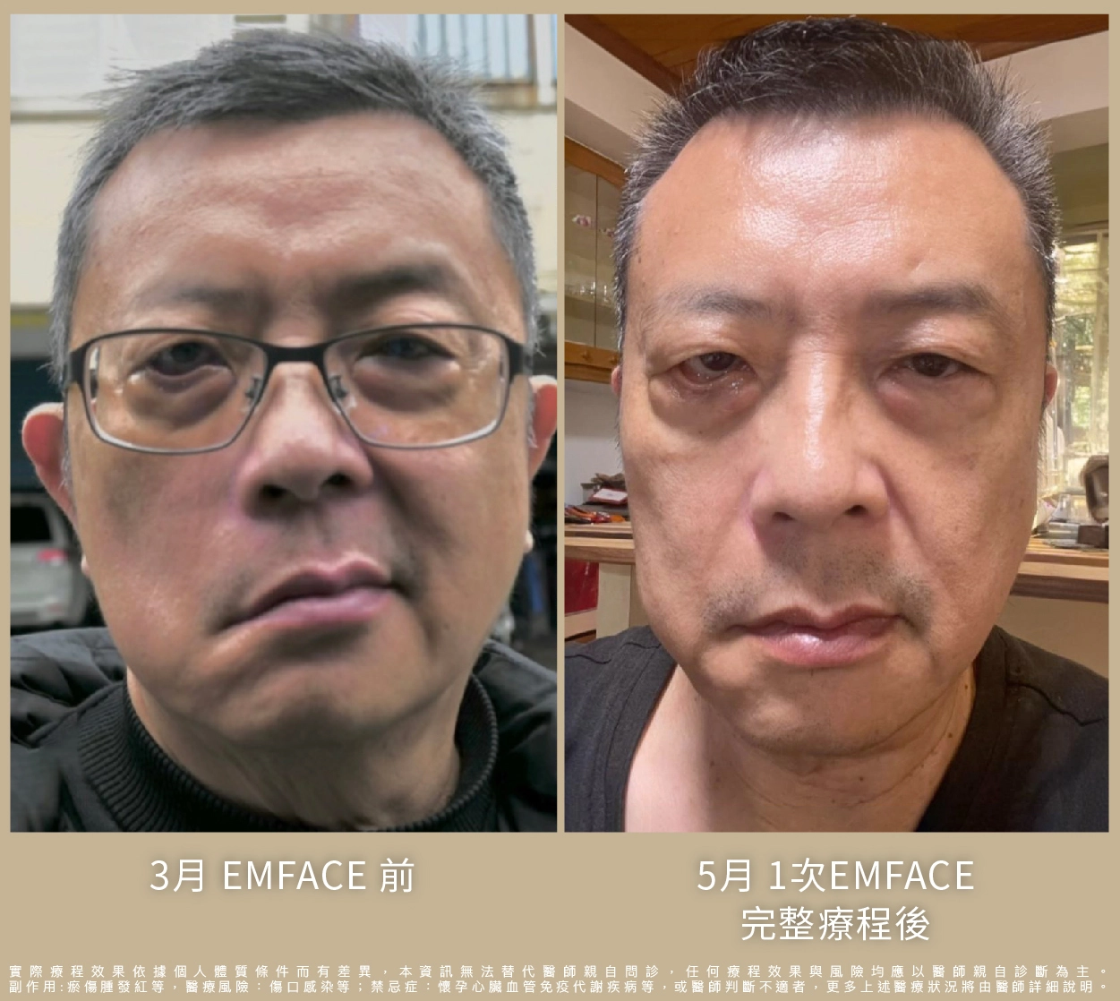 Emface治療過程