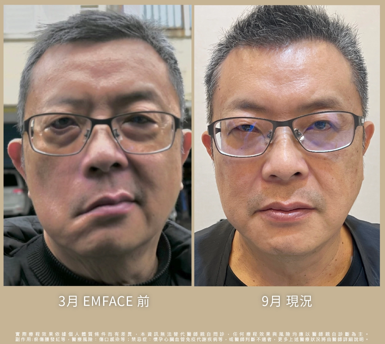 Emface治療過程