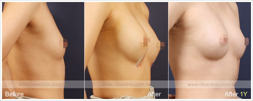自體脂肪隆乳豐胸案例術後追蹤 圖片