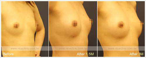 自體脂肪隆乳豐胸案例術後追蹤 圖片