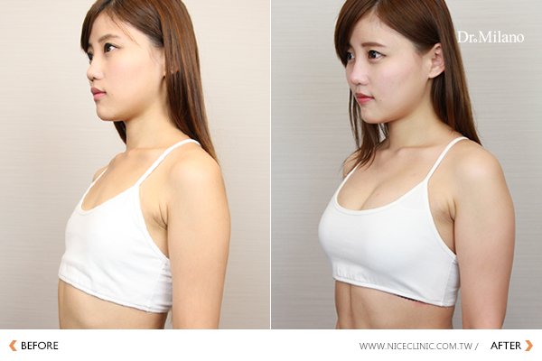 自體脂肪隆乳/豐胸減脂豐胸案例術後追蹤 圖片
