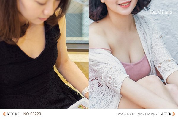 筱君 自體脂肪隆乳 術前術後差異照片