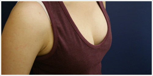 自體脂肪隆乳術後一周妮妮回診驗收 圖片