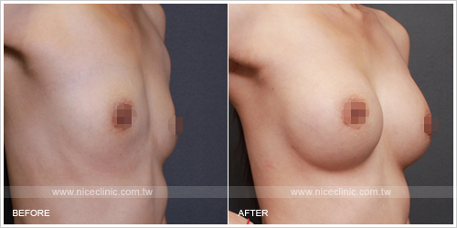 更多水滴型隆乳術前術後的照片