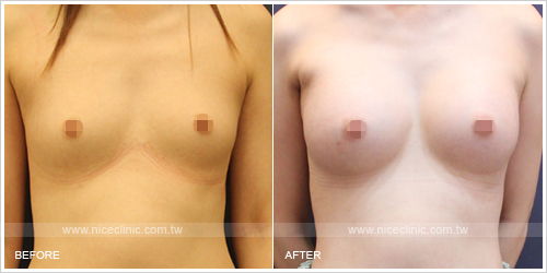 更多水滴型隆乳術前術後的照片