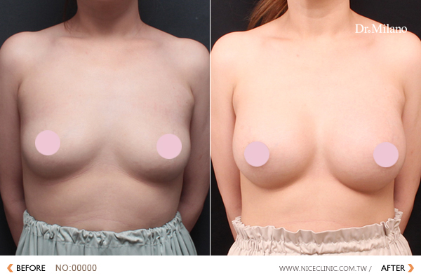 水滴型矽膠隆乳(矽膠豐胸) 術後 越南女孩小欣在台隆乳 滿意照