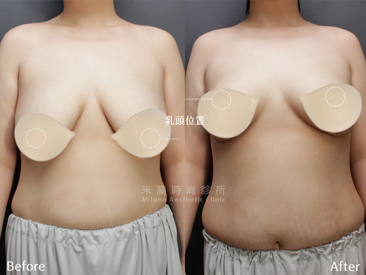 I型提乳手術案例