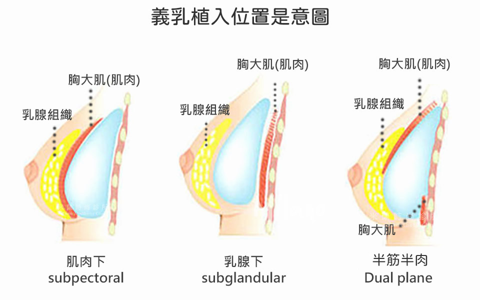 植體植入位置常見為筋膜層或胸大肌之下 圖片