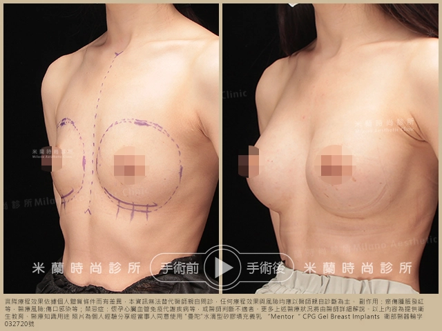 乳下緣切口 (IMF)案例