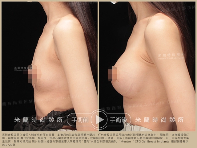 乳下緣切口 (IMF)案例