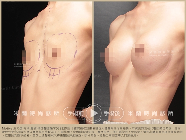 乳下緣切口 (IMF)案例