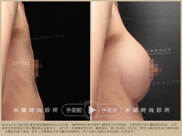 乳下緣切口 (IMF)案例
