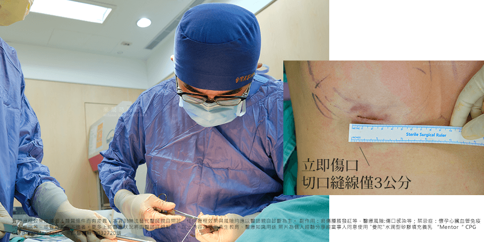 乳房下緣術後立即傷口切口縫線僅3公分