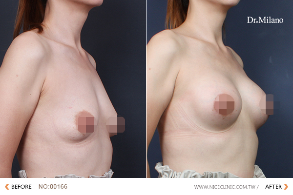 提乳手術案例 圖片