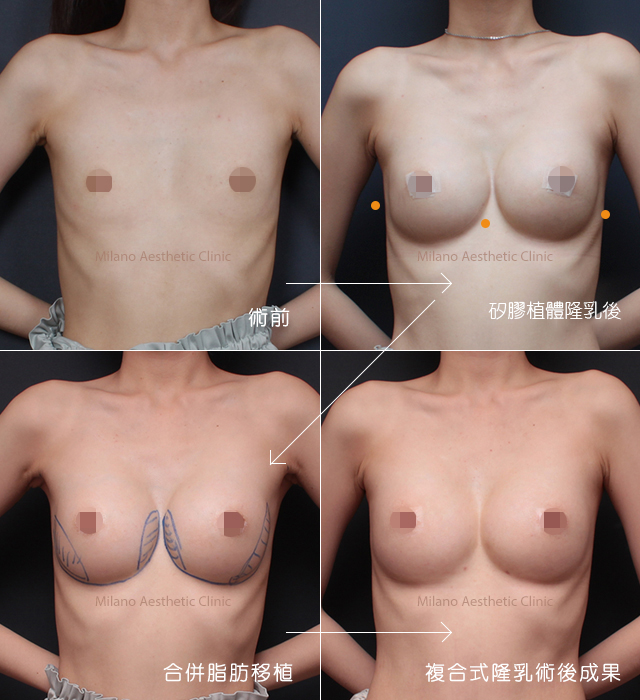 複合式隆乳手術前後照片