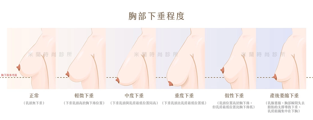胸部下垂程度分級示意圖，包含正常、輕微下垂、中度下垂、重度下垂、假性下垂與產後萎縮下垂。