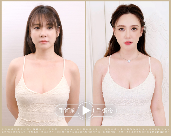自體脂肪隆乳