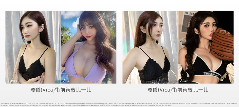 部落客瓊儀(Vica)隆乳後經驗分享