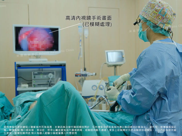 米蘭時尚診所楊善淳醫師執行魔滴隆乳手術，使用高階內視鏡微創技術精準剝離胸大肌畫面