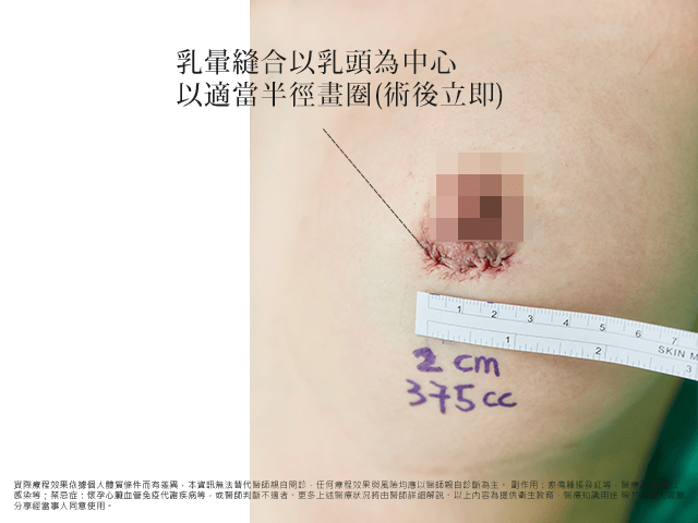 乳暈切口疤痕術後三個月