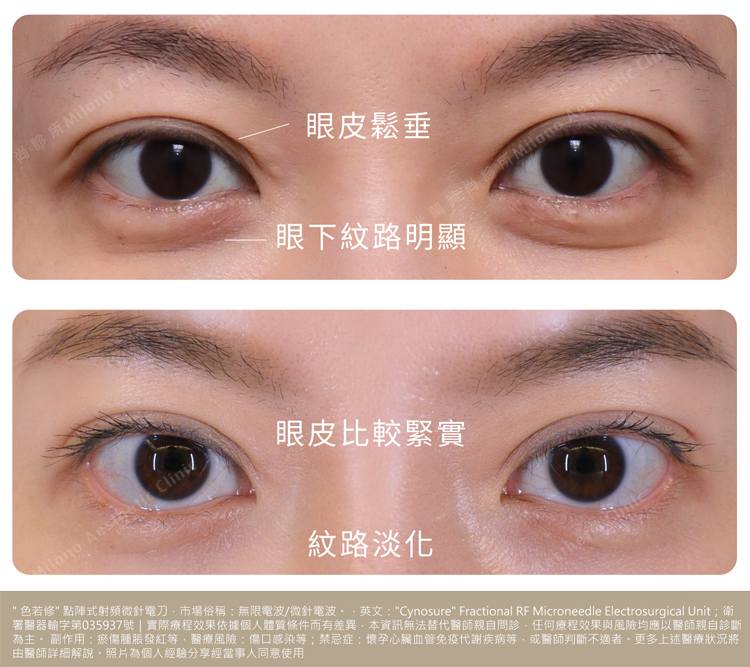 術後對比圖