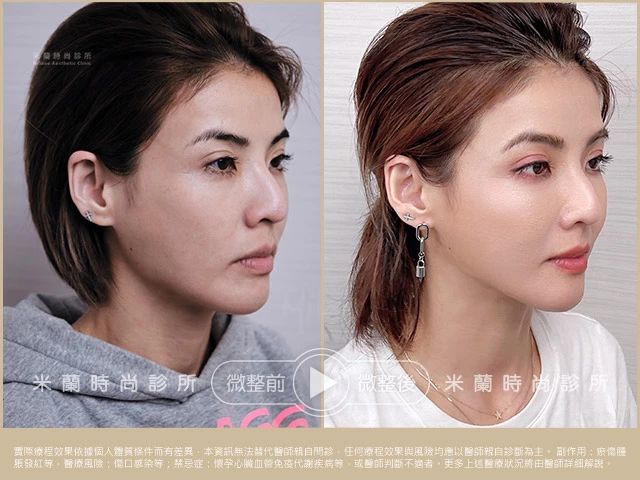 眼周電波術前術後比較