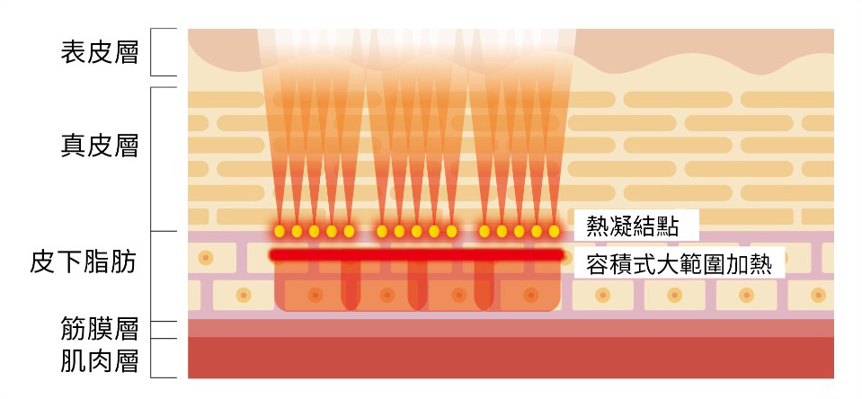 治療熱能會以容積式加熱的方式累積在臉部及身體部位