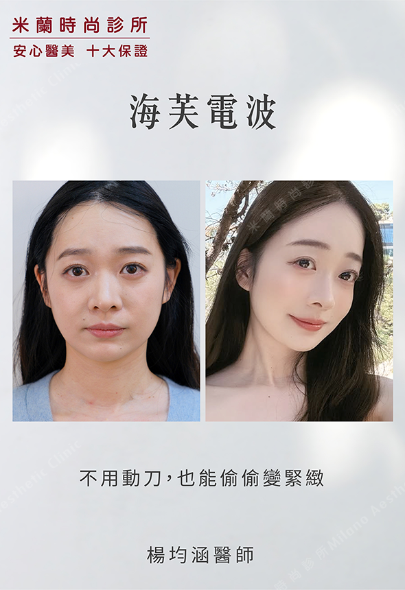 海芙電波術後兩個月對比圖