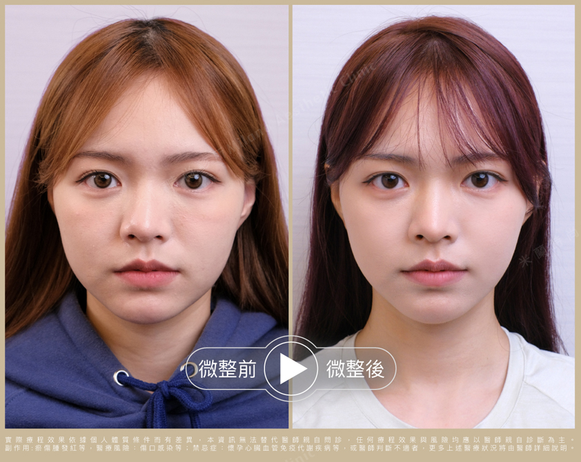 術後對比圖