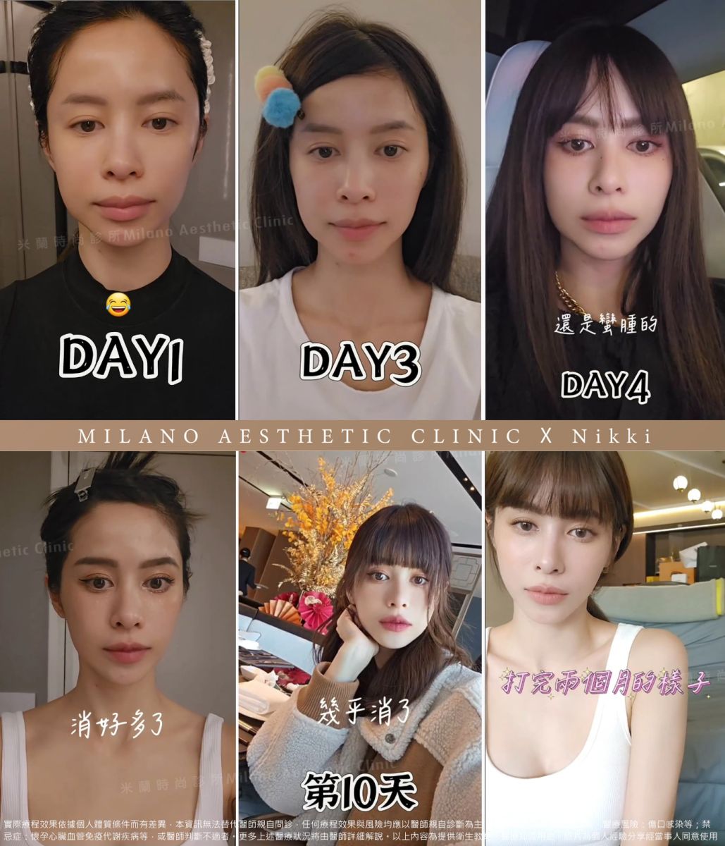 女神Nikki術後兩個月IG分享