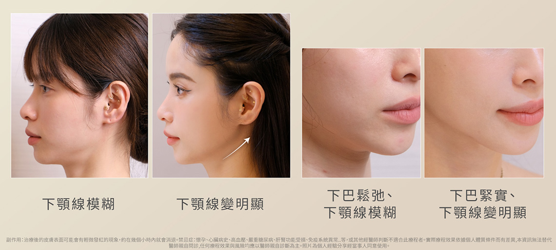 女神Nikki雙音波拉提術後效果