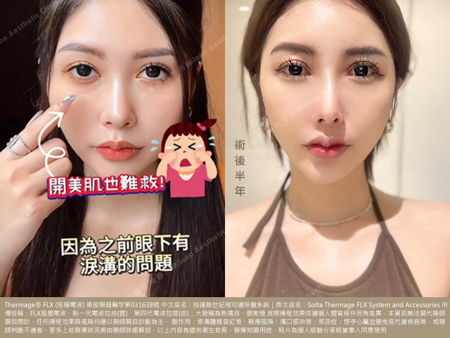 眼周電波術前術後比較