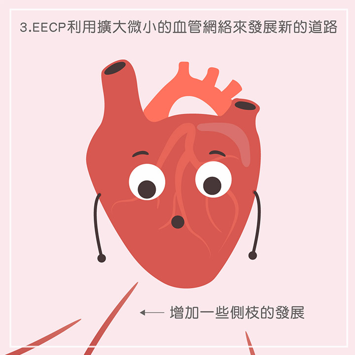 EECP利用擴大微小的血管網絡來發展新的道路