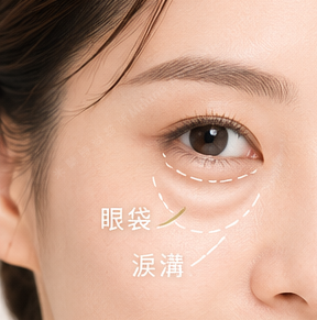 眼袋與淚溝位置示意圖｜米蘭時尚診所